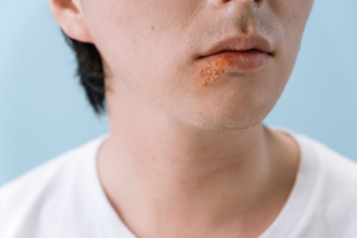 Mụn nước li ti và dịch mủ màu xanh vàng từ vết xăm