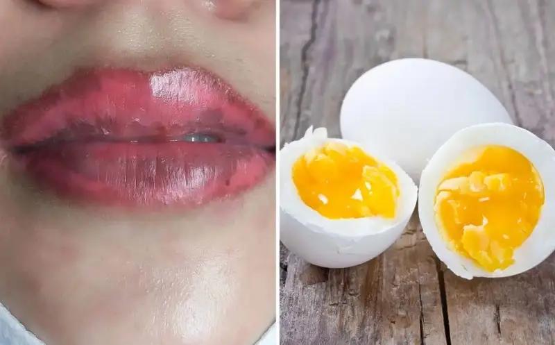 Vì sao phải cẩn trọng với chế độ ăn sau khử thâm môi?
